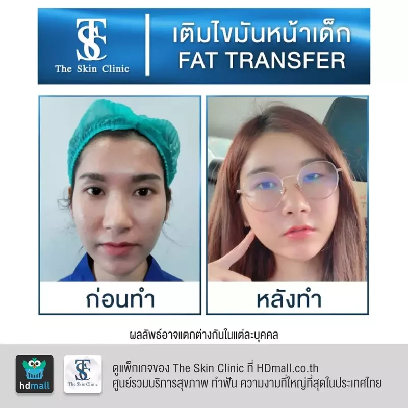 รีวิว เติมไขมันหน้า (ALMI Nano Fat) ที่ The Skin Clinic