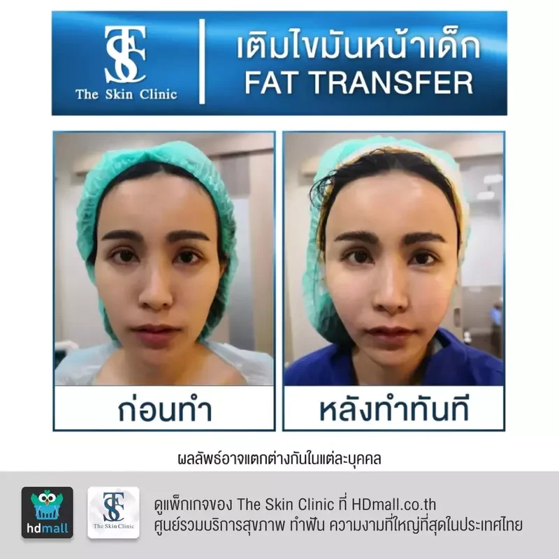 รีวิว เติมไขมันหน้า (ALMI Nano Fat) ที่ The Skin Clinic