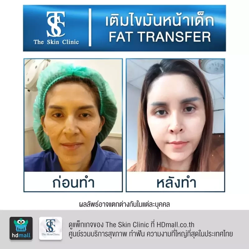 รีวิว เติมไขมันหน้า (ALMI Nano Fat) ที่ The Skin Clinic