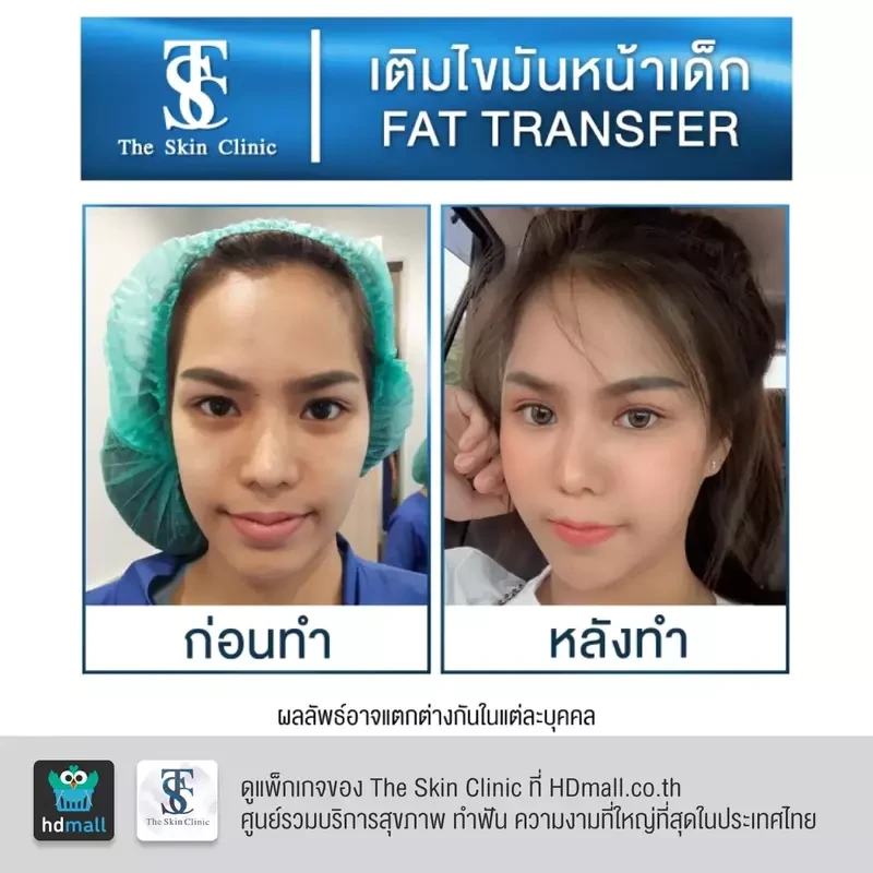 รีวิว เติมไขมันหน้า (ALMI Nano Fat) ที่ The Skin Clinic