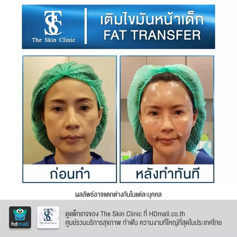 รีวิว เติมไขมันหน้า (ALMI Nano Fat) ที่ The Skin Clinic