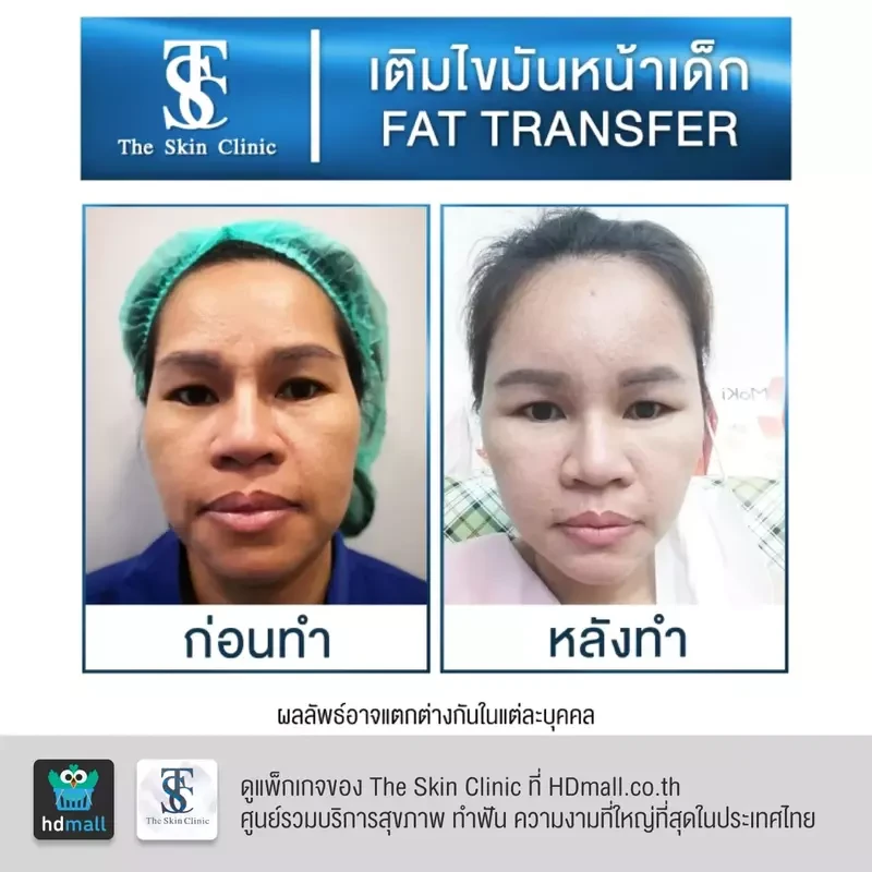 รีวิว เติมไขมันหน้า (ALMI Nano Fat) ที่ The Skin Clinic