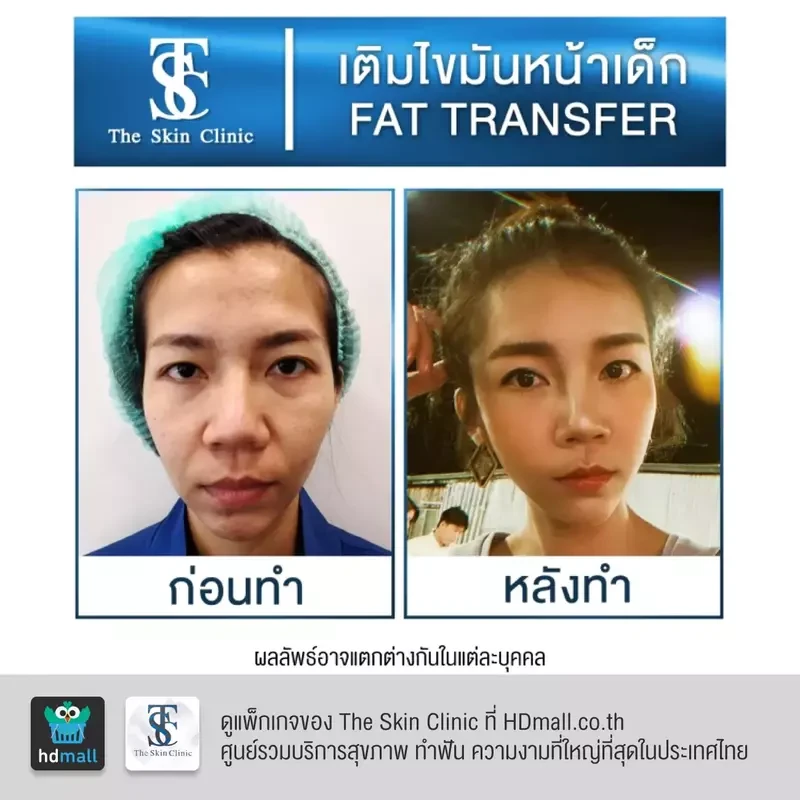 รีวิว เติมไขมันหน้า (ALMI Nano Fat) ที่ The Skin Clinic