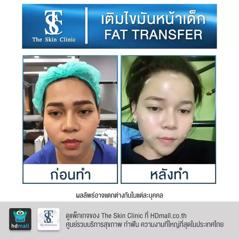 รีวิว เติมไขมันหน้า (ALMI Nano Fat) ที่ The Skin Clinic