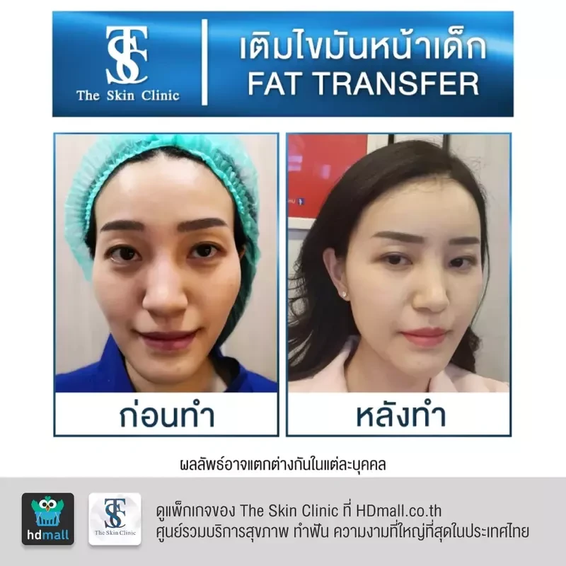 รีวิว เติมไขมันหน้า (ALMI Nano Fat) ที่ The Skin Clinic