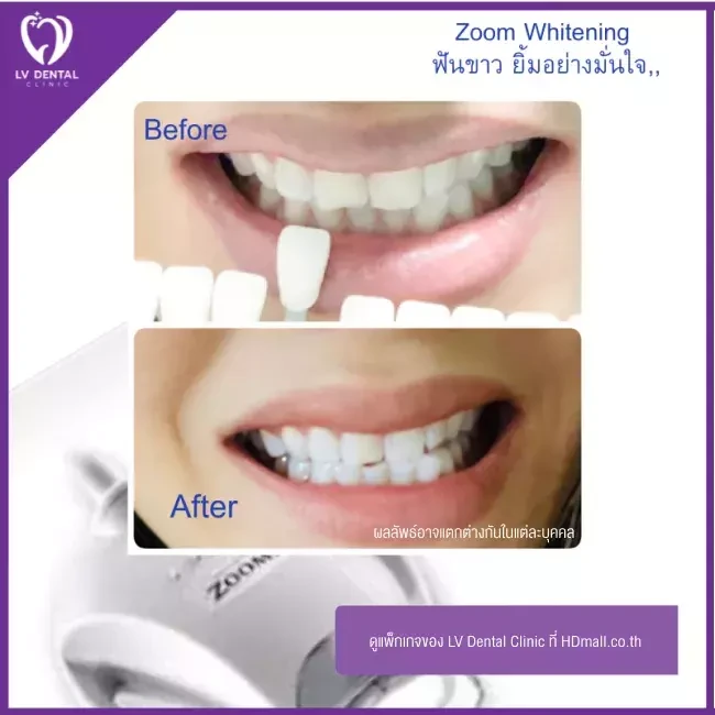 รีวิว ฟอกสีฟันแบบ Zoom ที่ LV Dental Clinic