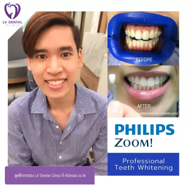 รีวิว ฟอกสีฟันแบบ Zoom ที่ LV Dental Clinic