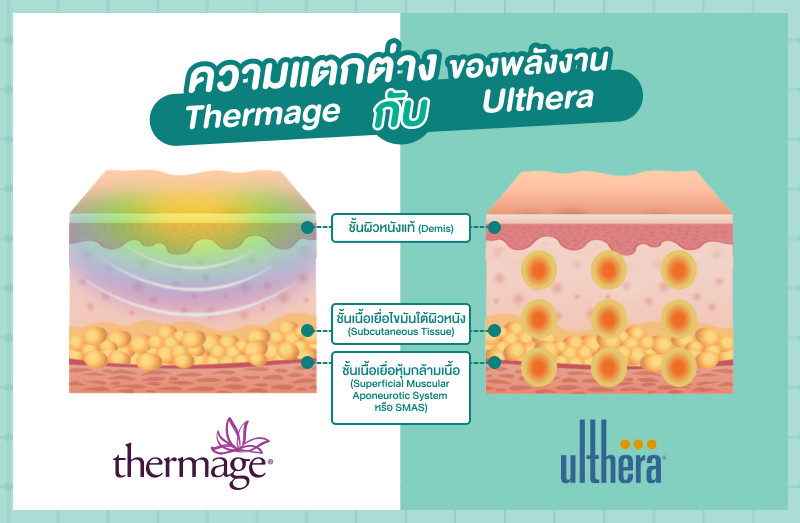 ความแตกต่างของ Thermage กับ Ulthera