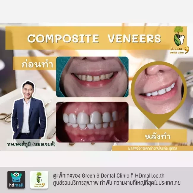 รีวิว เคลือบฟัน ทำวีเนียร์ ที่ Green 9 Dental Clinic