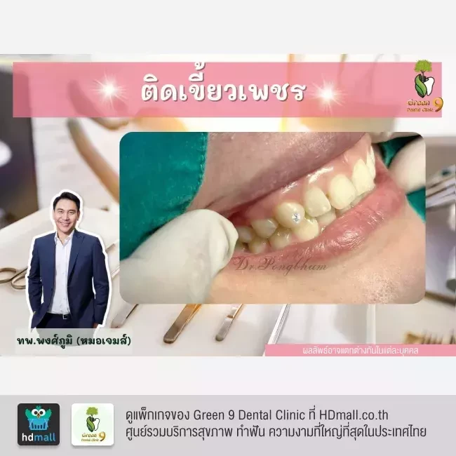 รีวิว ติดเพชรที่ฟัน ที่ Green 9 Dental Clinic