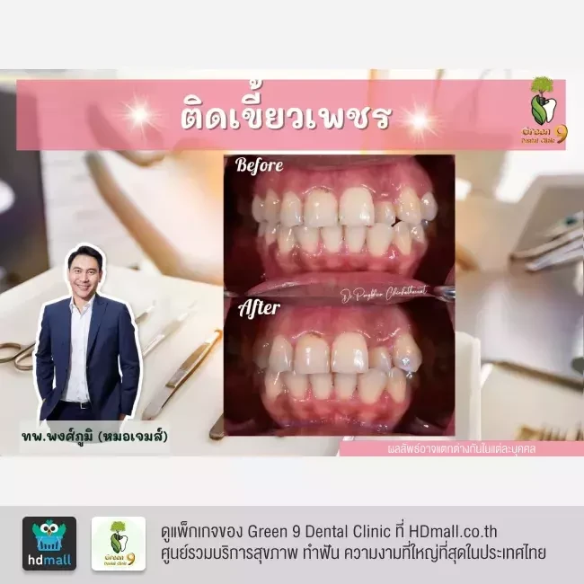 รีวิว ติดเพชรที่ฟัน ที่ Green 9 Dental Clinic