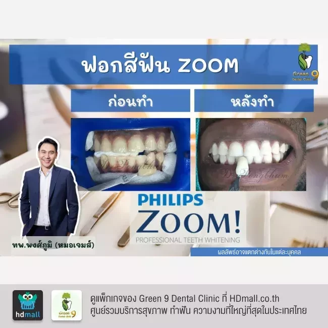 รีวิว ฟอกสีฟันแบบ Zoom ที่ Green 9 Dental Clinic