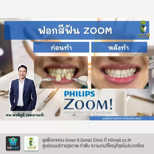 รีวิว ฟอกสีฟันแบบ Zoom ที่ Green 9 Dental Clinic