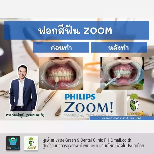 รีวิว ฟอกสีฟันแบบ Zoom ที่ Green 9 Dental Clinic