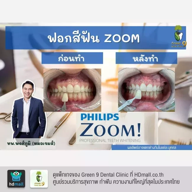 รีวิว ฟอกสีฟันแบบ Zoom ที่ Green 9 Dental Clinic