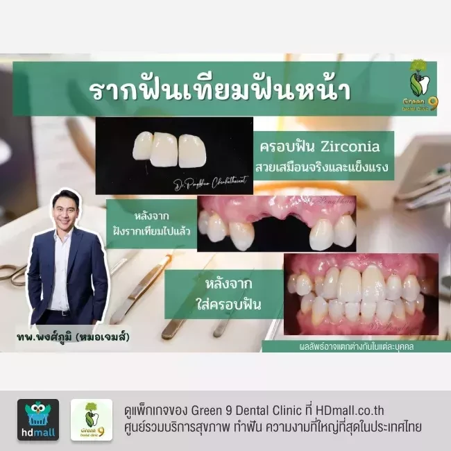 รีวิว ทำรากฟันเทียม ที่ Green 9 Dental Clinic