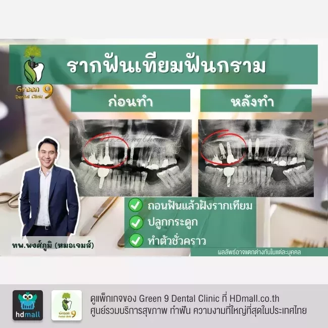 รีวิว ทำรากฟันเทียม ที่ Green 9 Dental Clinic