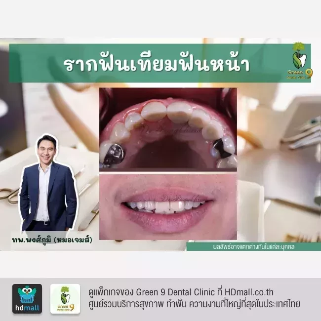 รีวิว ทำรากฟันเทียม ที่ Green 9 Dental Clinic