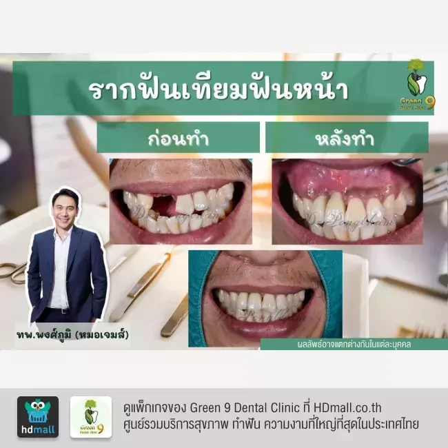รีวิว ทำรากฟันเทียม ที่ Green 9 Dental Clinic
