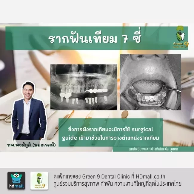 รีวิว ทำรากฟันเทียม ที่ Green 9 Dental Clinic