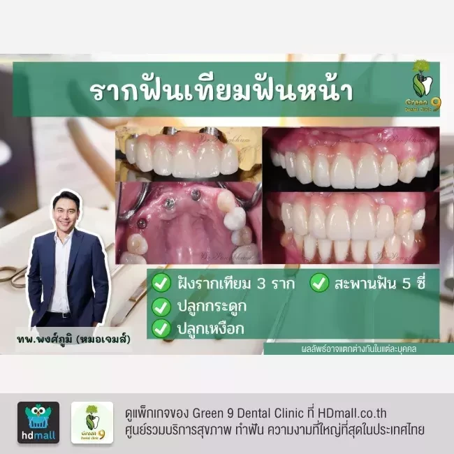 รีวิว ทำรากฟันเทียม ที่ Green 9 Dental Clinic