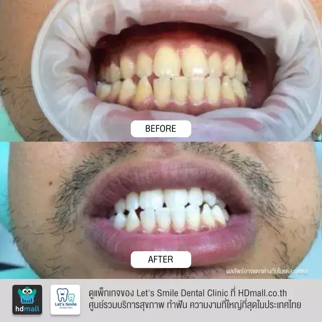 รีวิว ฟอกสีฟัน ที่ Let's Smile Dental Clinic