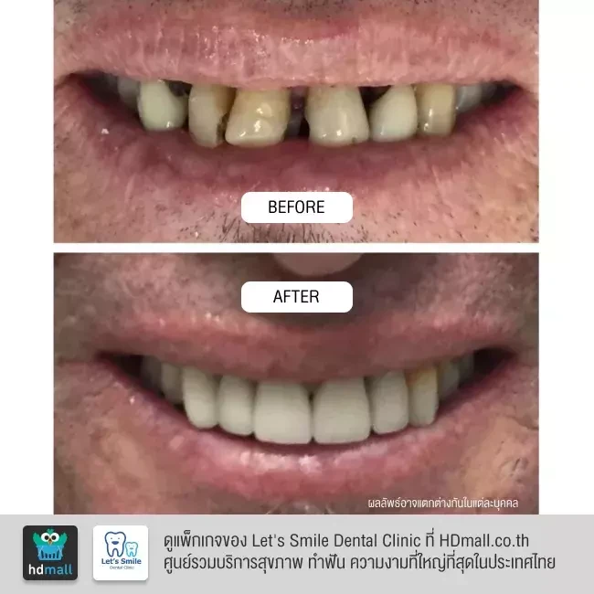 รีวิว ทำวีเนียร์ ที่ Let's Smile Dental Clinic