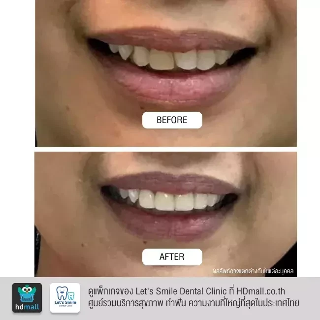 รีวิว ทำวีเนียร์ ที่ Let's Smile Dental Clinic