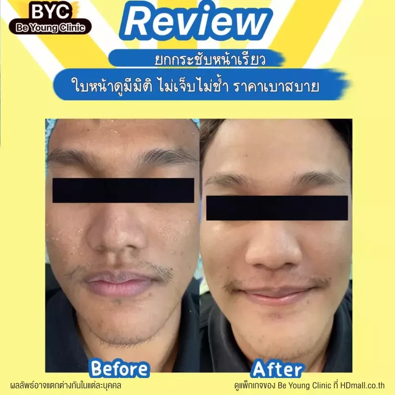 รีวิว ยกกระชับใบหน้า ด้วยเครื่อง Hydra Dermabrasion ที่ Be Young Clinic