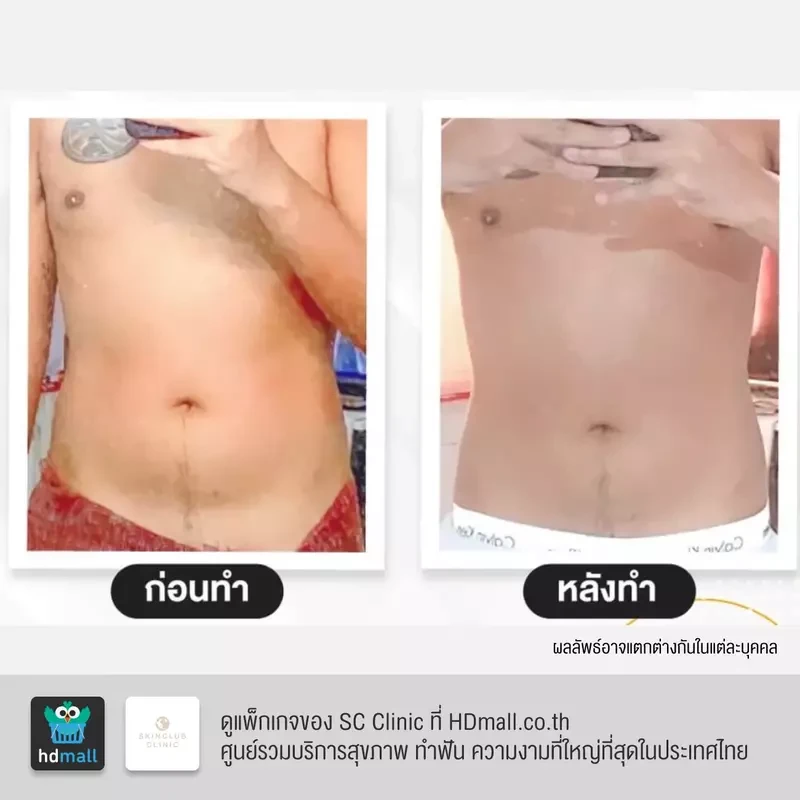 รีวิว สร้างกล้ามเนื้อ สลายไขมัน ด้วย HIFEM บริเวณหน้าท้อง ที่ SC Clinic