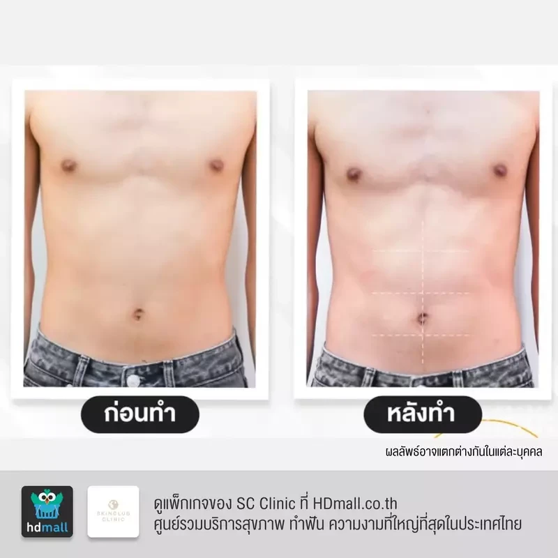 รีวิว สร้างกล้ามเนื้อ สลายไขมัน ด้วย HIFEM บริเวณหน้าท้อง ที่ SC Clinic