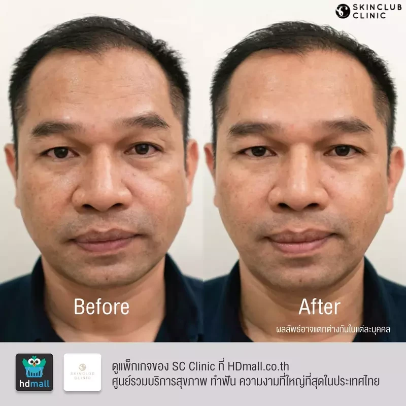 รีวิว ฉีดโบท็อกซ์ ที่ SC Clinic รูปที่ 2