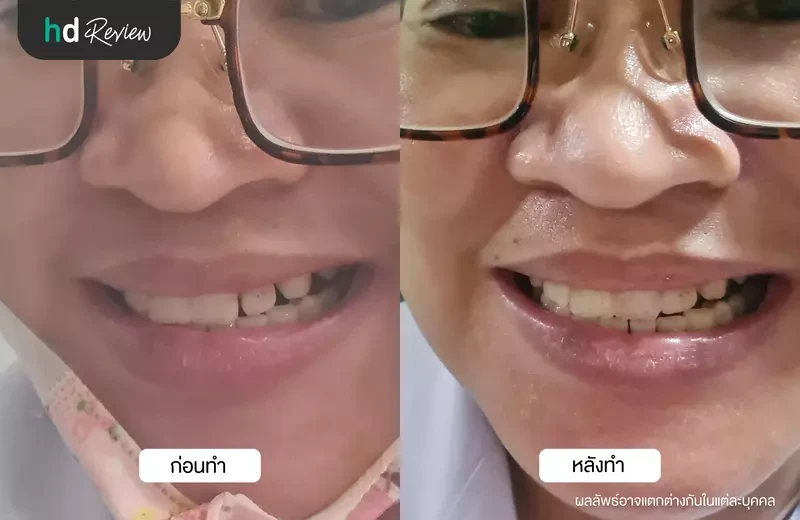 ภาพเปรียบก่อนและหลังอุดฟันปิดช่องฟันห่าง ที่ หน้ามอ ทันตกรรม