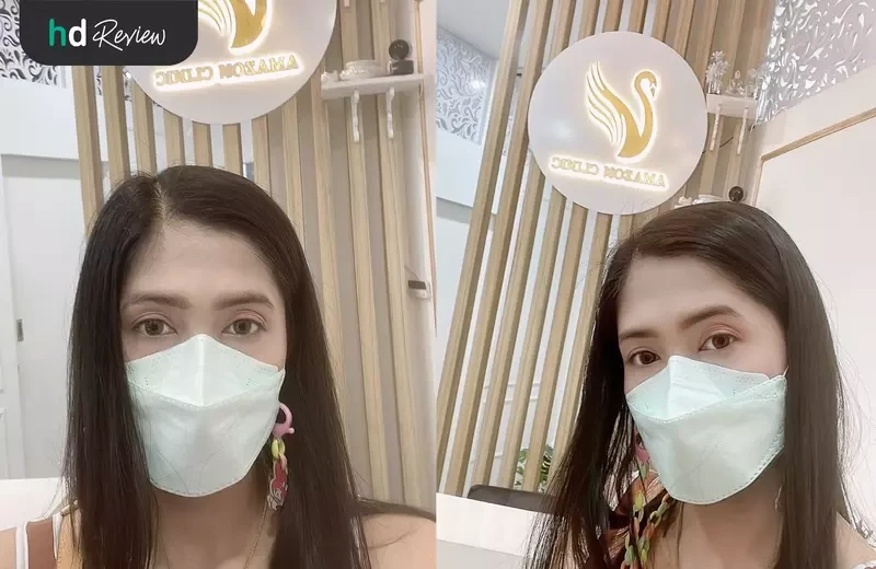 ผู้ใช้บริการกำจัดขน Hollywood ด้วย Diode Laser ที่ Amazon Clinic