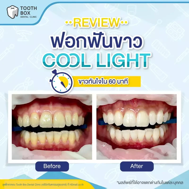 รีวิว ฟอกสีฟันแบบ Cool light ที่ Tooth Box Dental Clinic (คลินิกทันตกรรมทูธบอกซ์)
