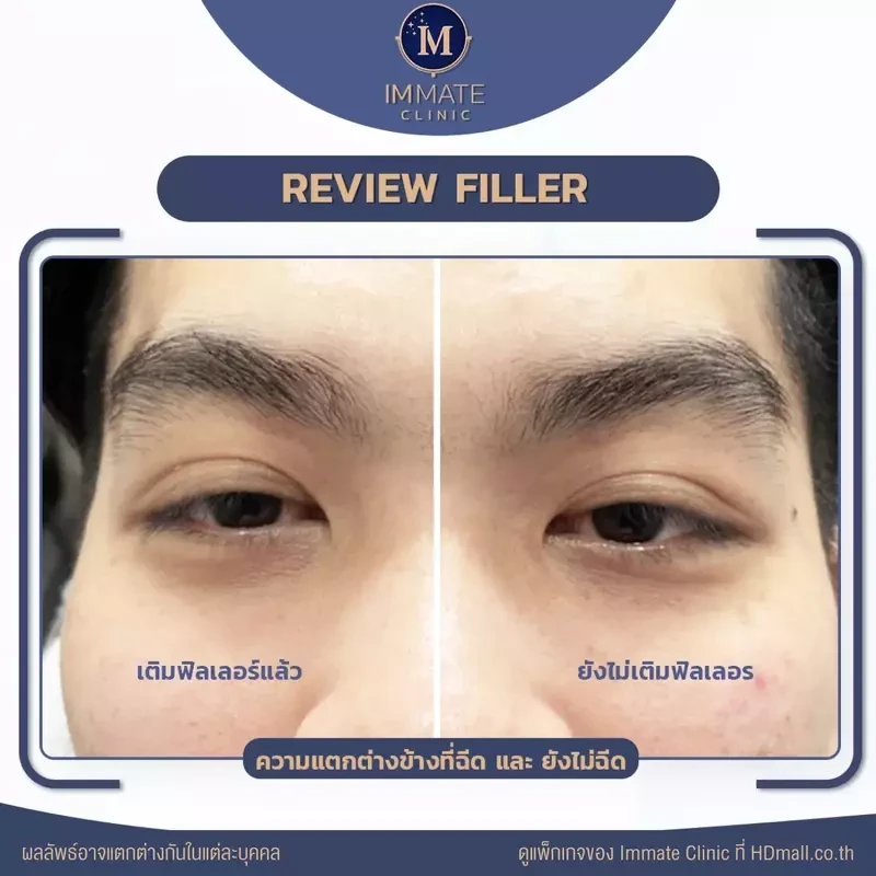 รีวิว ฉีดฟิลเลอร์ Yvoire ที่ Immate Clinic