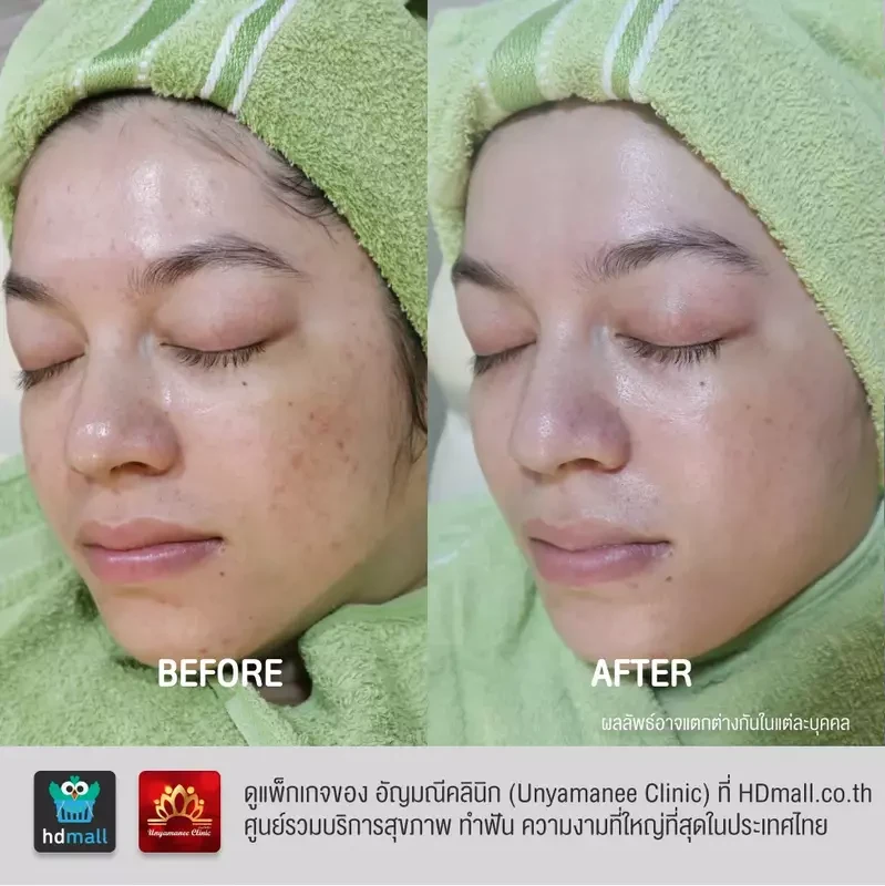 รีวิว ฉีดมาเด้คอลลาเจน ที่ อัญมณีคลินิก Unyamanee clinic