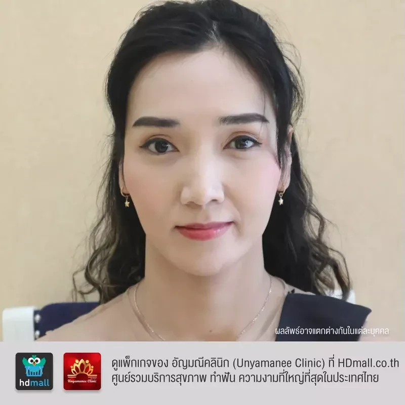 รีวิว ฉีดมาเด้คอลลาเจน ที่ อัญมณีคลินิก Unyamanee clinic