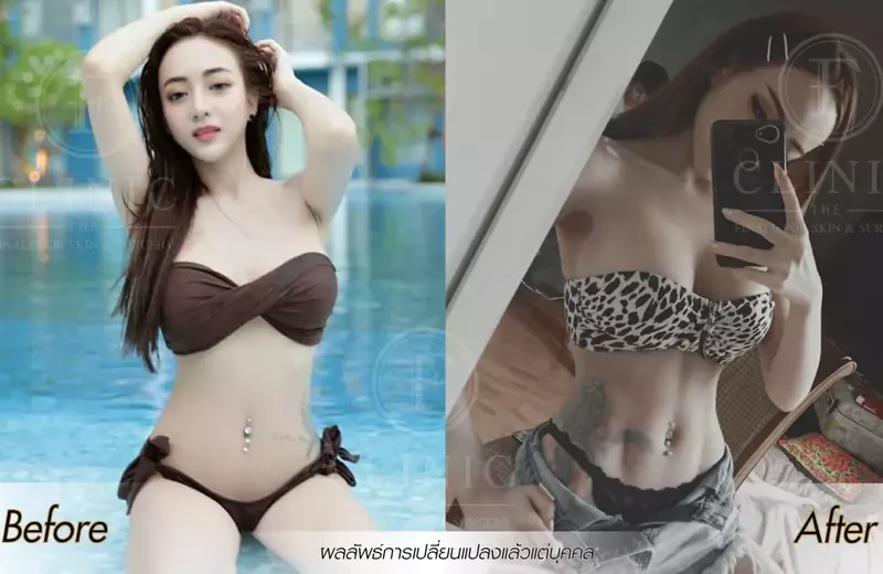 ภาพเปรียบเทียบก่อนและหลังดูดไขมัน Sexy Line (เซ็กซี่ไลน์) ร่อง 11 ที่ F Clinic