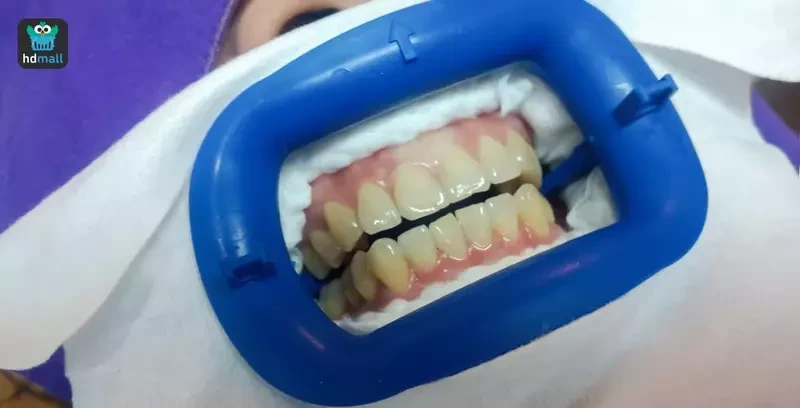 ใส่อุปกรณ์ป้องกันขอบเหงือกในช่องปากทั้งบนและล่าง ก่อนฟอกสีฟัน