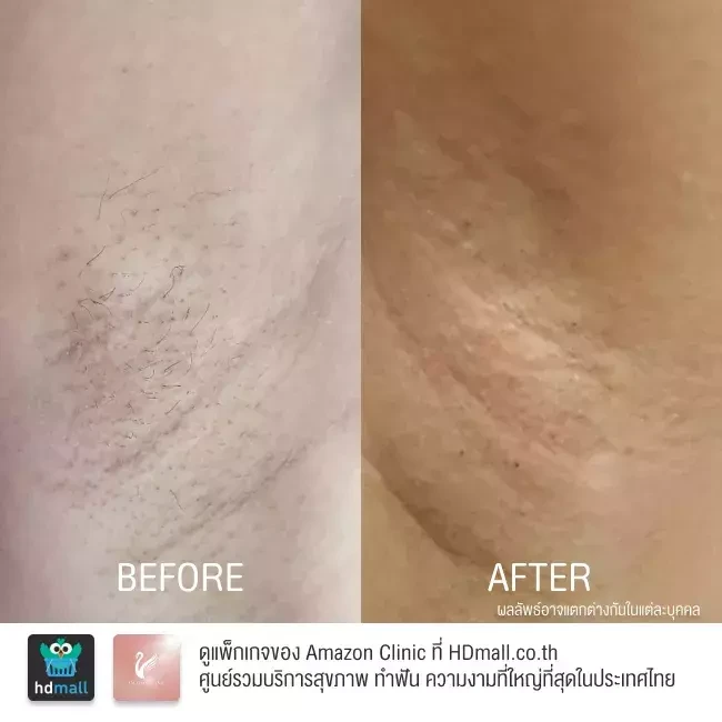 รีวิว เลเซอร์กำจัดขนรักแร้ ที่ Amazon Clinic