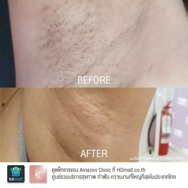 รีวิว เลเซอร์กำจัดขนรักแร้ ที่ Amazon Clinic