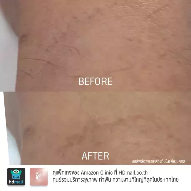 รีวิว เลเซอร์กำจัดขนรักแร้ ที่ Amazon Clinic