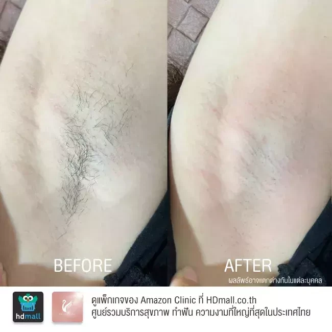 รีวิว เลเซอร์กำจัดขนรักแร้ ที่ Amazon Clinic