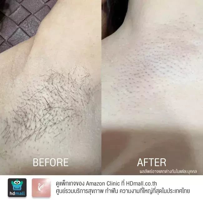 รีวิว เลเซอร์กำจัดขนรักแร้ ที่ Amazon Clinic