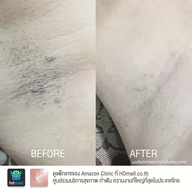 รีวิว เลเซอร์กำจัดขนรักแร้ ที่ Amazon Clinic