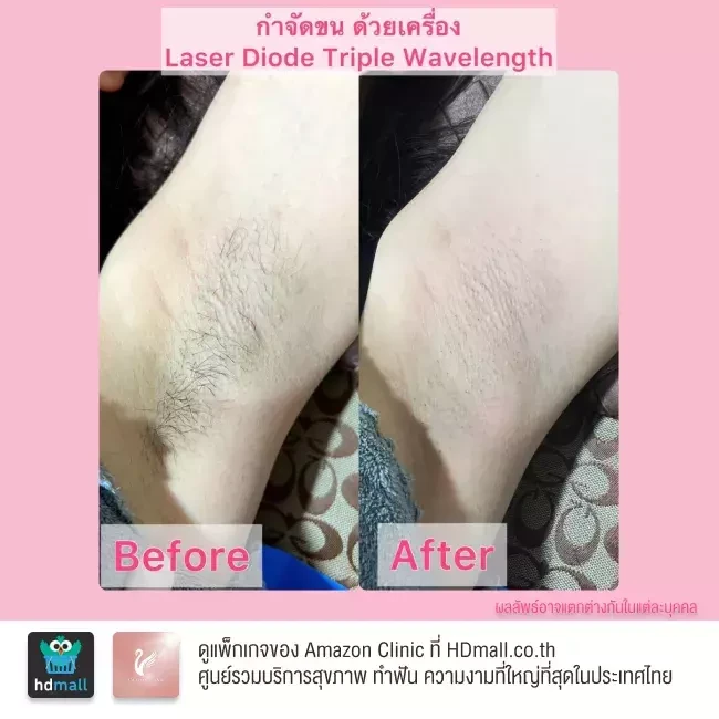 รีวิว เลเซอร์กำจัดขนรักแร้ ที่ Amazon Clinic