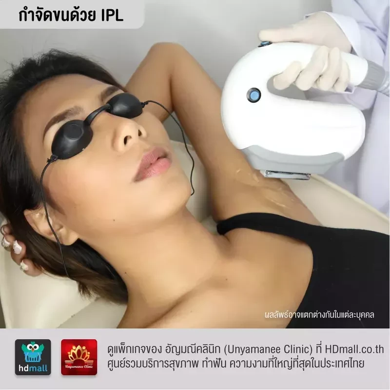 รีวิว กำจัดขนรักแร้ ที่ อัญมณีคลินิก Unyamanee clinic