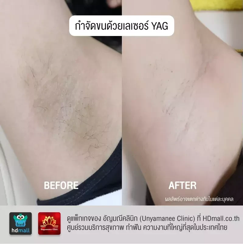 รีวิว กำจัดขนรักแร้ ที่ อัญมณีคลินิก Unyamanee clinic