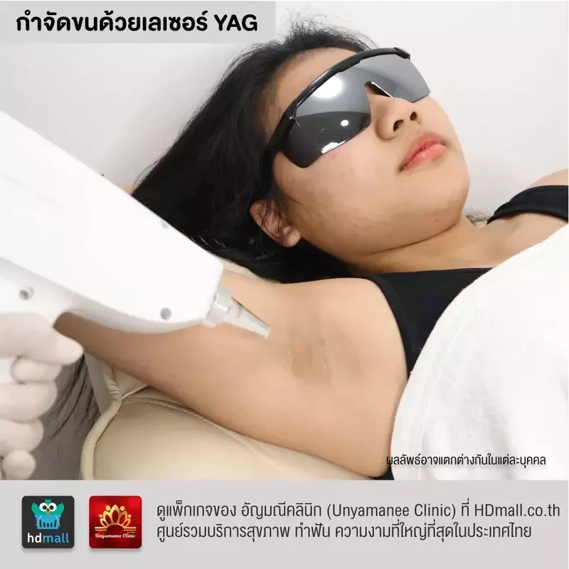 รีวิว กำจัดขนรักแร้ ที่ อัญมณีคลินิก Unyamanee clinic